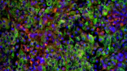 Unter dem Mikroskop: Grün gefärbte Neuroblastomzellen in einem Gewebeschnitt der Nebenniere. 