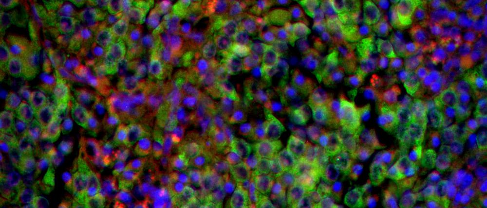 Unter dem Mikroskop: Grün gefärbte Neuroblastomzellen in einem Gewebeschnitt der Nebenniere.