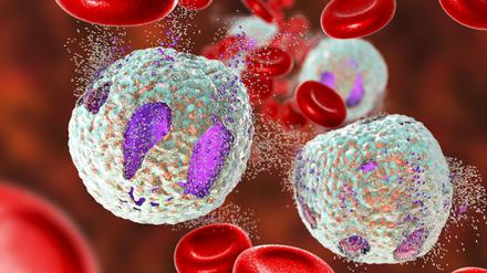Computersimulation der Behandlung einer akuten lymphatischen Leukämie