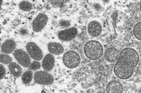 Elektronenmikroskopische Aufnahme des Centers for Disease Control and Prevention zeigt reife, ovale Affenpockenviren (l) und kugelförmige unreife Virionen (r).