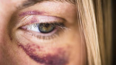 Immer mehr Frauen lassen ihre Verletzungen bei der Gewaltschutzambulanz der Charité dokumentieren.