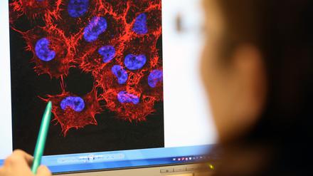 In einem Labor schaut eine Doktorandin auf ein Monitorbild von Melanom-Zellen (schwarzer Hautkrebs). 