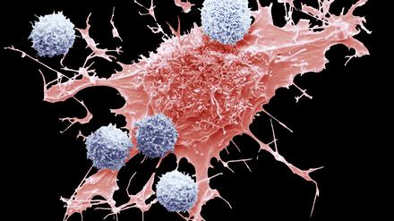 T-Zellen der Patienten können, gentechnisch aufgepeppt, wieder fit für den Kampf gegen Krebs gemacht werden. Blutkrebs können diese „CAR-T-Zellen“ heilen, in Zukunft vielleicht auch solide Tumore. 