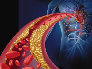 Rote Blutkörperchen strömen durch verengte Blutgefäße in Richtung Herz (Illustration).