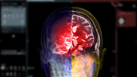 CTA brain and mri brain fusion image