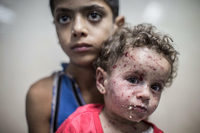 Für viele verletzte Kinder gibt es im Gazastreifen keine Behandlungsmöglichkeiten.