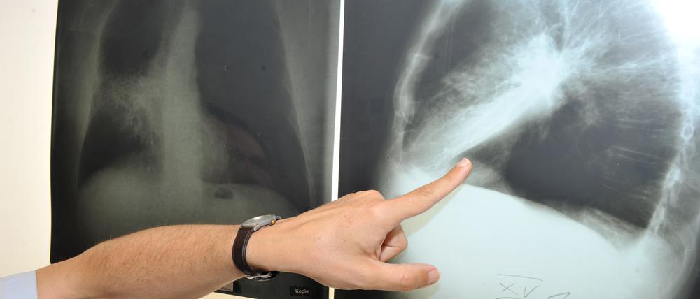 ARCHIV - Die Hand des Leiters der Pneumologie (Lungenheilkunde) zeigt am 17.06.2010 in München (Oberbayern) im Klinikum der Universität München auf ein Röntgenbild einer mit Krebs befallenen Lunge. Die Sterberate für Krebs sinkt in der Europäischen Union (EU) insgesamt - allerdings bei Frauen weniger stark als bei Männern. Foto: Felix Hörhager/dpa +++(c) dpa - Bildfunk+++ | Verwendung weltweit