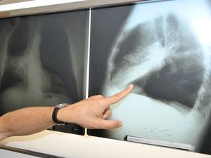ARCHIV - Die Hand des Leiters der Pneumologie (Lungenheilkunde) zeigt am 17.06.2010 in München (Oberbayern) im Klinikum der Universität München auf ein Röntgenbild einer mit Krebs befallenen Lunge. Die Sterberate für Krebs sinkt in der Europäischen Union (EU) insgesamt - allerdings bei Frauen weniger stark als bei Männern. Foto: Felix Hörhager/dpa +++(c) dpa - Bildfunk+++ | Verwendung weltweit