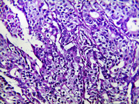 Eingefärbte Magenkrebszellen unter dem Mikroskop.