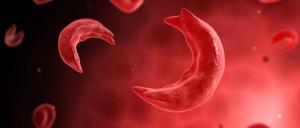 Bei der Sichelzellkrankheit verklebt Hämoglobin die roten Blutkörperchen, die sich so verformen.