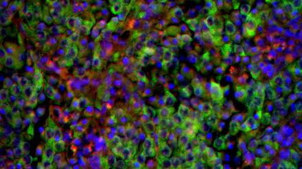 Unter dem Mikroskop: Grün gefärbte Neuroblastomzellen in einem Gewebeschnitt der Nebenniere. 