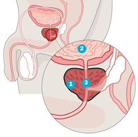 Die Prostata (1) sitzt unter der Harnblase (2) und umschließt einen Teil der Harnröhre (3). Die kastaniengroße Drüse mischt dem Samen ein milchiges Sekret bei, dass die Fortbewegung der Spermien ermöglicht. Prostatakrebs ist die häufigste Tumorerkrankung beim Mann. Ja nach Krankheitsstadium und Art des Tumors gibt es verschiedene Therapieoptionen - die operative Entfernung der Prostata, Bestrahlung, Chemo- oder Hormontherapie. Manchmal ist Abwarten die beste Option, da der Tumor oft sehr langsam wächst.