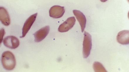 Mikroskopfoto zeigt halbmondförmige rote Blutkörperchen eines an Sichelzellenanämie erkrankten Patienten aus dem Jahr 1972. 