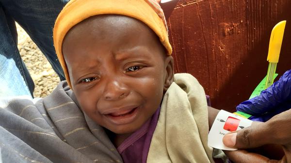 Somalia, einer der Hotspots bitterer Not, hier im Sommer dieses Jahres: Rachid, ein schwer unterernährtes Baby, wird in einer Klinik vermessen. 