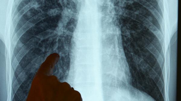 Deutschland registriert mehr Tuberkulosefälle 