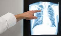Röntgenbild einer Lunge (Foto zur Illustration)