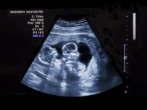 Ultrasound of Identical Twins