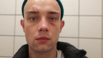 Der junge Ukrainer nach der Attacke: die Ärzte stellen Gesichtsprellungen und eine Verletzung an der Hand fest. 