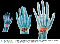 Die Röntgenuntersuchung der Handwurzelknochen (links von einem Zweijährigen, mittig von einem Siebenjährigen und rechts von einem Erwachsenen) soll sich das Alter junger Menschen auf etwa ein Jahr genau bestimmen lassen.