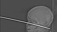 Röntgenbild des 10-jährigen Jungen mit Metallspieß im Kopf.