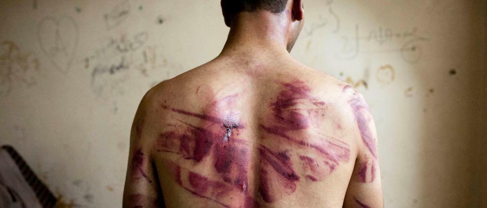 Schwere Menschenrechtsverletzungen. Das Regime Assad unterdrückt mit extremer Gewalt jegliche Form von Kritik und Opposition. Im Bild ein Folteropfer, das überlebt hat.