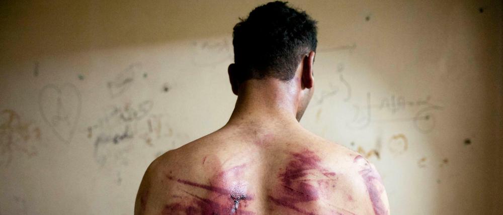 Ein Syrer zeigt Spuren von erlittener Folter (Archivbild)