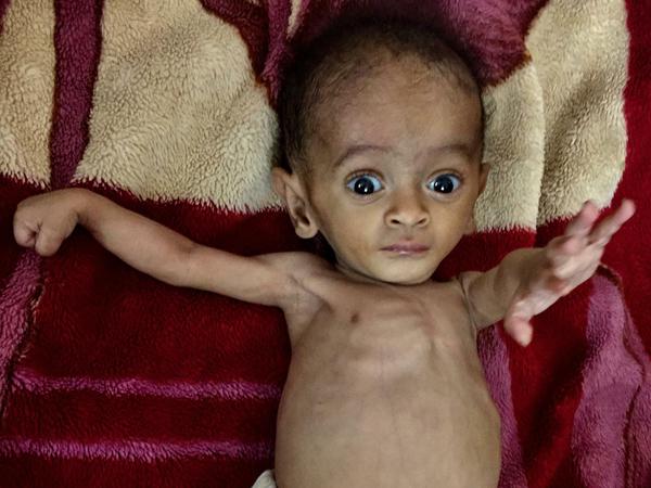Dem acht Monate alten Abdulrahman droht der Hungertod.