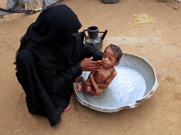 Der Krieg im Jemen ist für die Menschen eine Katastrophe. Viele Familien hungern, vor allem Kinder.