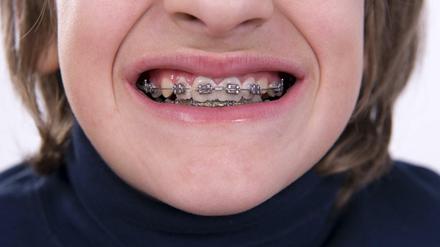 Medizinisch notwendig oder nur für die Optik? In Deutschland bekommt jeder zweite Jugendliche eine Zahnspange.