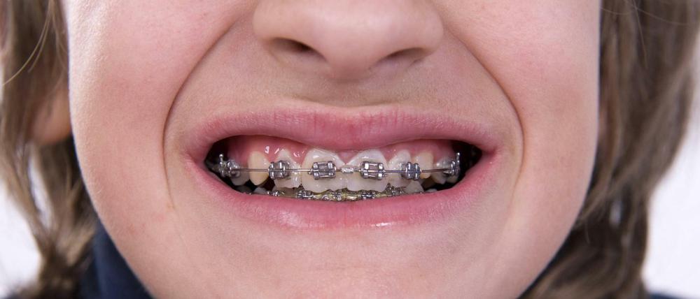 Medizinisch notwendig oder nur für die Optik? In Deutschland bekommt jeder zweite Jugendliche eine Zahnspange.