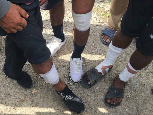 Migranten aus Pakistan zeigen Verletzungen an den Beinen und behaupten, dass diese ihnen bei Misshandlungen durch kroatische Grenzpolizisten zugefügt wurden.