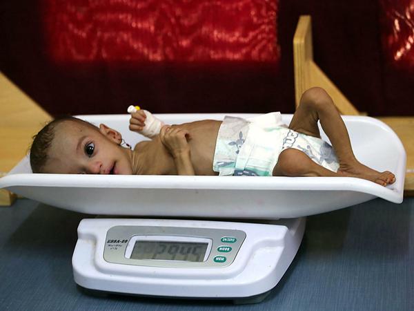 Kinder im Jemen sind oft dramatisch unterernährt.