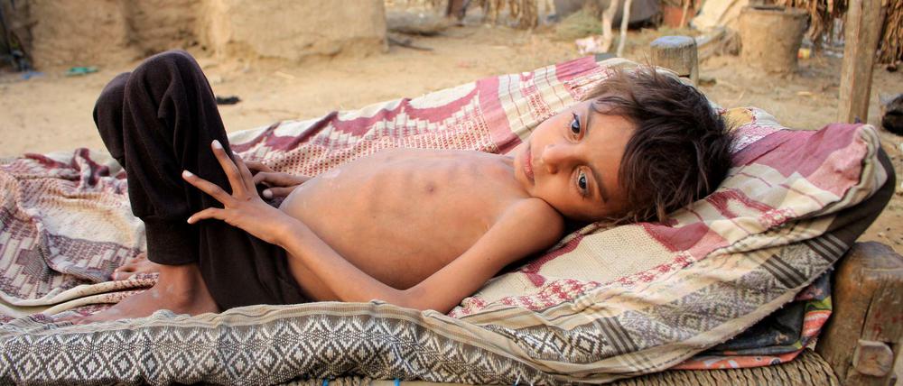 Ein unterernährter Junge im Jemen. 