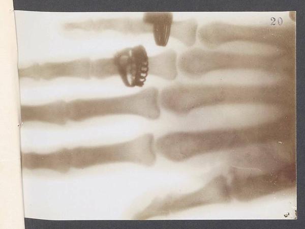 Röngtenbild von der Hand von Marie Kundt, 1896.