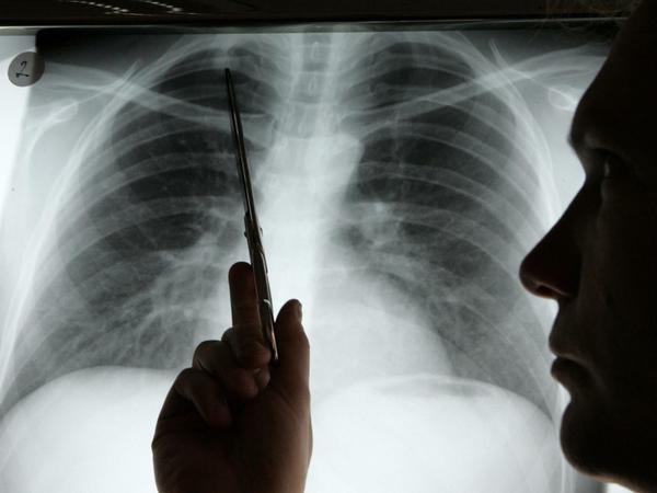 Diagnose Lungenkrebs. Experten rechnen damit, dass die Zahl der Krebserkrankungen zunimmt. Die gute Nachricht: Die Heilungschancen steigen. 