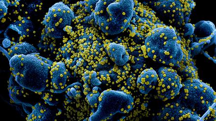 Befallene Zellen (blau) produzieren neue Viruspartikel (gelb).