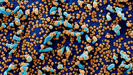 Sars-CoV-2-Viruspartikel (orange) treten aus einer stark infizierten Blutzelle (blau) aus, die einem Patienten entnommen wurde (eingefärbte elektronenmikroskopische Aufnahme).