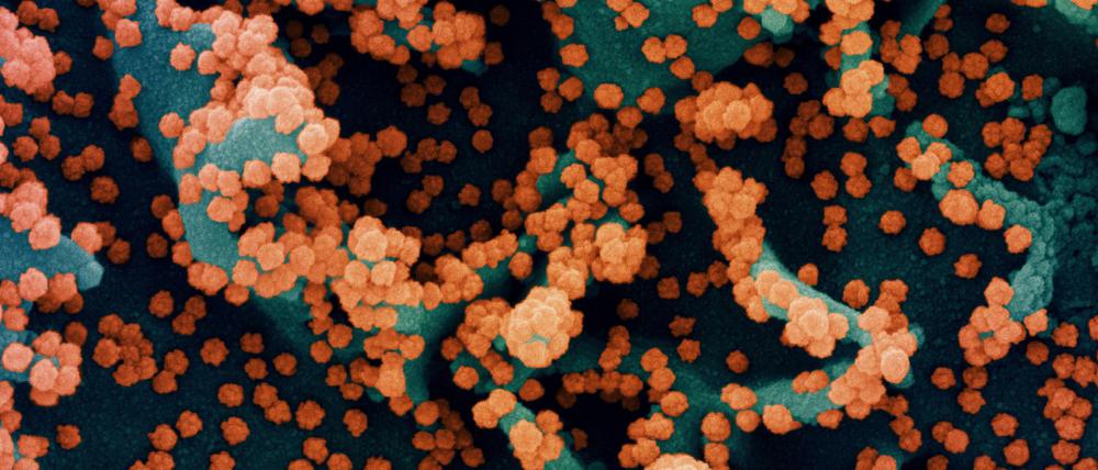 Sars-CoV-2 unterwirft befallene Zellen seiner eigenen Vermehrung. Die meisten sterben durch die Produktion neuer Viren ab.