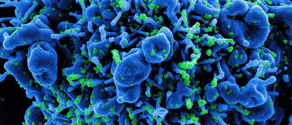Am Ende des Vermehrungszyklus in einer infizierten Zelle (blau) schnüren sich neue Virenpartikel von der Zelloberfläche ab.