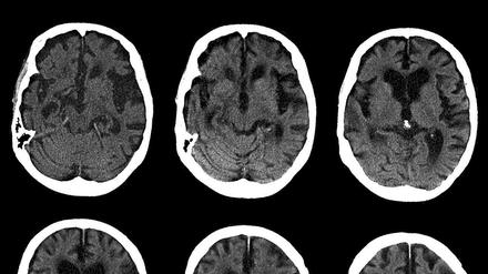 Ausgehöhlt. Das Gehirn eines Alzheimer-Patienten in einer computertomographischen Aufnahme.