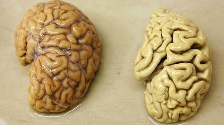 Der Gedächtnisverlust geht mit Nervenschwund einher. Das Hirn von Alzheimer-Patienten (rechts) schrumpft infolge der Erkrankung.