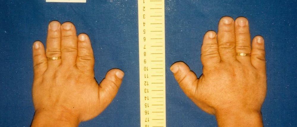 An den verkürzten Fingern (oben die Hände einer betroffenen Frau) können Mitglieder einer türkischen Familie erkennen, ob sie bereits in jungen Jahren an Bluthochdruck erkranken. Die Kurzfingrigkeit wird in dieser Familie immer mit dem Bluthochdruck gemeinsam vererbt. Im unteren Bild zum Vergleich die Hände einer nicht erkrankten Frau. 