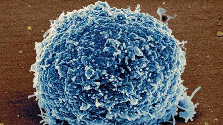 Tumoren "besänftigen" die Immunabwehr und wiegen sie in trügerische Ruhe.