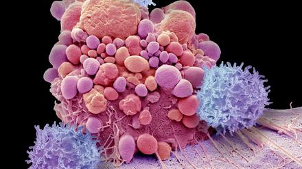 Damit T-Zellen ((lila) wieder in die Lage versetzt werden, Krebszellen (hier eine Hirntumorzelle, rosa) anzugreifen, verändern Forscher ihr Erbgut. Jetzt hat diese "CAR-T"-Zelltherapie genannte Methode auch mit der Gen-Schere CRISPR-Cas9 funktioniert.