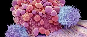 Damit T-Zellen ((lila) wieder in die Lage versetzt werden, Krebszellen (hier eine Hirntumorzelle, rosa) anzugreifen, verändern Forscher ihr Erbgut. Jetzt hat diese "CAR-T"-Zelltherapie genannte Methode auch mit der Gen-Schere CRISPR-Cas9 funktioniert.