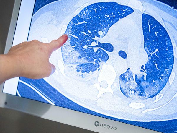 Ein behandelnder Arzt zeigt auf die CT-Aufnahme der Lunge eines Patienten, der sich mit dem Coronavirus infiziert hat. 