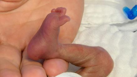 In der Hand einer Pflegekraft liegt der rechte Fuß eines fünf Tage alten Jungen.