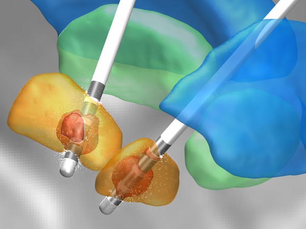 Zwei Elektroden stimulieren in dieser Illustration den Nucleus subthalamicus, einen Teil des Zwischenhirns, der wichtig für die Verarbeitung von Bewegungsimpulsen ist. Die Stimulation kann Patienten mit Parkinson helfen.