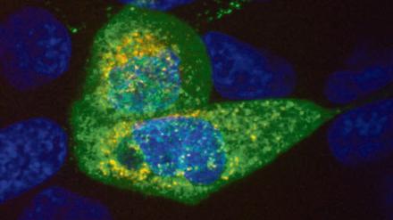 Gemengelage. In Lungenzellen, die mit Sars-CoV-2 (grün) infiziert sind, kann sich so viel Virus-RNA (rot) ansammeln, dass einige Bruchstücke offenbar in bestimmten Fällen in das menschliche Erbgut (blau) eindringen können.  