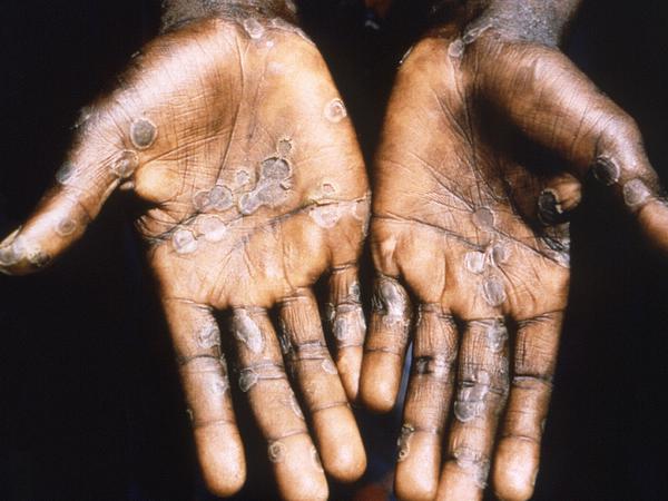 Dieses Bild aus dem Jahr 1997 entstand während einer Untersuchung eines Affenpockenausbruchs in der Demokratischen Republik Kongo (DRC).